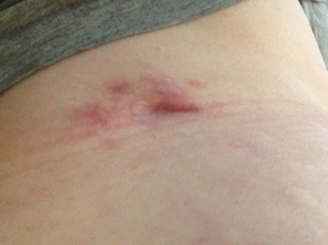 Nephrostomy tube scar approx 3.5 months after surgery